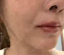 脂肪溶解注射（顔） Nクリニック伏見 DAY 1 サムネイル用