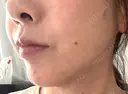 脂肪溶解注射（顔） Nクリニック伏見 DAY 1 サムネイル用
