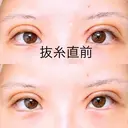 二重切開 アネシス美容クリニック DAY 5 サムネイル用