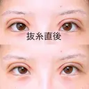 二重切開 アネシス美容クリニック DAY 5 サムネイル用