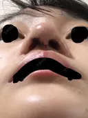 鼻尖形成（切開） 三輪皮フ科形成外科 DAY 2 サムネイル用