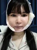 鼻修正 / 切開リフト / 鼻翼基部形成（貴族手術） リッツ美容外科 東京院 DAY 24 サムネイル用