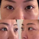 クマ治療 EMMO FACE CLINIC 東京三田院 DAY 14 サムネイル用