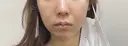 ボトックス（エラ・小顔） ルラ美容クリニック 名古屋本院 DAY 4 サムネイル用