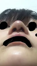 鼻尖形成（切開） 三輪皮フ科形成外科 DAY 3 サムネイル用