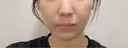 ボトックス（エラ・小顔） ルラ美容クリニック 名古屋本院 DAY 5 サムネイル用