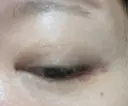 ヒアルロン酸注入（涙袋） アネシス美容クリニック DAY 8 サムネイル用