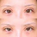 二重切開 アネシス美容クリニック DAY 7 サムネイル用