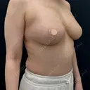 脂肪吸引（脚） / 豊胸（脂肪注入） / 脂肪注入（目の下） 湘南美容クリニック 吉祥寺院 DAY 28 サムネイル用