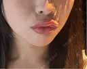 ヒアルロン酸注入（唇） Code Beauty Clinic 名古屋院 DAY 0 サムネイル用