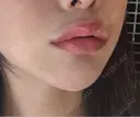 ヒアルロン酸注入（唇） Code Beauty Clinic 名古屋院 DAY 0 サムネイル用