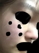 鼻尖形成（切開） 三輪皮フ科形成外科 DAY 4 サムネイル用