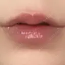 ヒアルロン酸注入（唇） AZ BEAUTY CLINIC AFTER サムネイル用