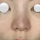 隆鼻術 / 鼻尖形成（切開） / 小鼻縮小（切開） / 軟骨移植 / 眉間プロテーゼ / 鼻修正 / 鼻尖縮小 / 鼻柱下降・鼻唇角形成（猫手術） / その他（鼻） グローバルビューティークリニック 銀座院 AFTER サムネイル用
