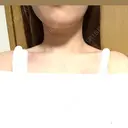 ボトックス（エラ・小顔） / ボトックス（肩） 新未来クリニック DAY 1 サムネイル用