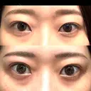 二重埋没 湘南美容クリニック 池袋東口院 AFTER サムネイル用