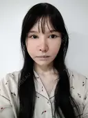 鼻修正 / 切開リフト / 鼻翼基部形成（貴族手術） リッツ美容外科 東京院 DAY 28 サムネイル用