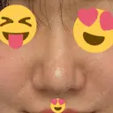 鼻尖形成（切開） / 軟骨移植 / 鼻尖縮小 / 鼻翼基部形成（貴族手術） / ヒアルロン酸注入（鼻翼基部） 東京シンデレラ美容外科 新宿院 AFTER サムネイル用