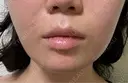 ボトックス（エラ・小顔） / ボトックス（肩） BiBiクリニック AFTER サムネイル用