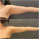 脂肪吸引（二の腕） / 脂肪吸引（背中） オアシス美容外科 DAY 49 サムネイル用