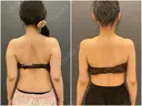 脂肪吸引（二の腕） / 脂肪吸引（背中） オアシス美容外科 DAY 49 サムネイル用