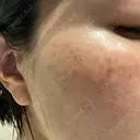 イオン導入 / ルメッカ ルラ美容クリニック 大宮院 / ルラスキンクリニック 大宮院 DAY 0 サムネイル用