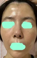 その他（肌） / ダーマペン スキンリファインクリニック銀座 DAY 3 サムネイル用