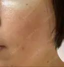 その他（肌） / ダーマペン スキンリファインクリニック銀座 DAY 3 サムネイル用