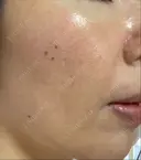 その他（肌） / ダーマペン スキンリファインクリニック銀座 DAY 3 サムネイル用