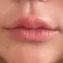 ヒアルロン酸注入（唇） / ボトックス（タレ目） / ボトックス（人中） アネシス美容クリニック AFTER サムネイル用