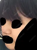 鼻尖形成（切開） 三輪皮フ科形成外科 DAY 6 サムネイル用