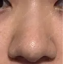 鼻尖形成（切開） / 軟骨移植 / 鼻柱下降・鼻唇角形成（猫手術） 東京美専クリニック DAY 12 サムネイル用