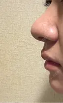 鼻尖形成（切開） / 軟骨移植 / 鼻柱下降・鼻唇角形成（猫手術） 東京美専クリニック DAY 12 サムネイル用