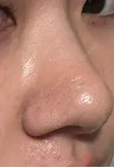 鼻尖形成（切開） / 軟骨移植 / 鼻柱下降・鼻唇角形成（猫手術） 東京美専クリニック DAY 12 サムネイル用