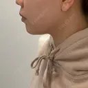 脂肪溶解注射（顔） フォンタナクリニック天神 AFTER サムネイル用
