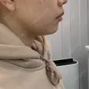 脂肪溶解注射（顔） フォンタナクリニック天神 DAY 13 サムネイル用