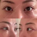 クマ治療 EMMO FACE CLINIC 東京三田院 DAY 19 サムネイル用