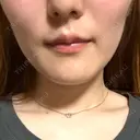 ボトックス（エラ・小顔） / ボトックス（肩） 新未来クリニック DAY 4 サムネイル用