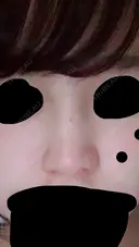 鼻尖形成（切開） 三輪皮フ科形成外科 AFTER サムネイル用