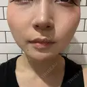 ボトックス（あご） / ボトックス（エラ・小顔） / ボトックス（肩） TCB東京中央美容外科 堺院 DAY 3 サムネイル用