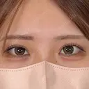 二重埋没 / 上まぶたの脂肪取り アリエル美容クリニック 横浜院 AFTER サムネイル用