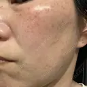 イオン導入 / ルメッカ ルラ美容クリニック 大宮院 / ルラスキンクリニック 大宮院 DAY 2 サムネイル用