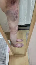 脂肪吸引（お尻） アムルーズ美容外科クリニック 横浜院 DAY 3 サムネイル用