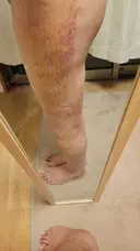 脂肪吸引（お尻） アムルーズ美容外科クリニック 横浜院 DAY 10 サムネイル用