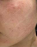 ピーリング（ハリ・ツヤ） / ルメッカ PureMe Skin Clinic（ピュアミースキンクリニック麻布） DAY 0 サムネイル用