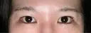 目尻切開 / タレ目形成・グラマラスライン（埋没） LOUIS CLINIC 二子玉川院【ルイクリニック】 DAY 2 サムネイル用