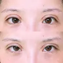 二重切開 アネシス美容クリニック DAY 14 サムネイル用