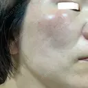 イオン導入 / ルメッカ ルラ美容クリニック 大宮院 / ルラスキンクリニック 大宮院 DAY 4 サムネイル用