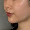 肌ヒアルロン酸注入（たるみ・シワ改善） / ヒアルロン酸注入（あご） アリエル美容クリニック 大宮院 DAY 0 サムネイル用