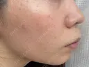 ポテンツァ ルラ美容クリニック 札幌本院 DAY 5 サムネイル用